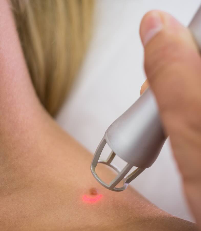 Dermatologist removing mole from womans shoulder with medical laser