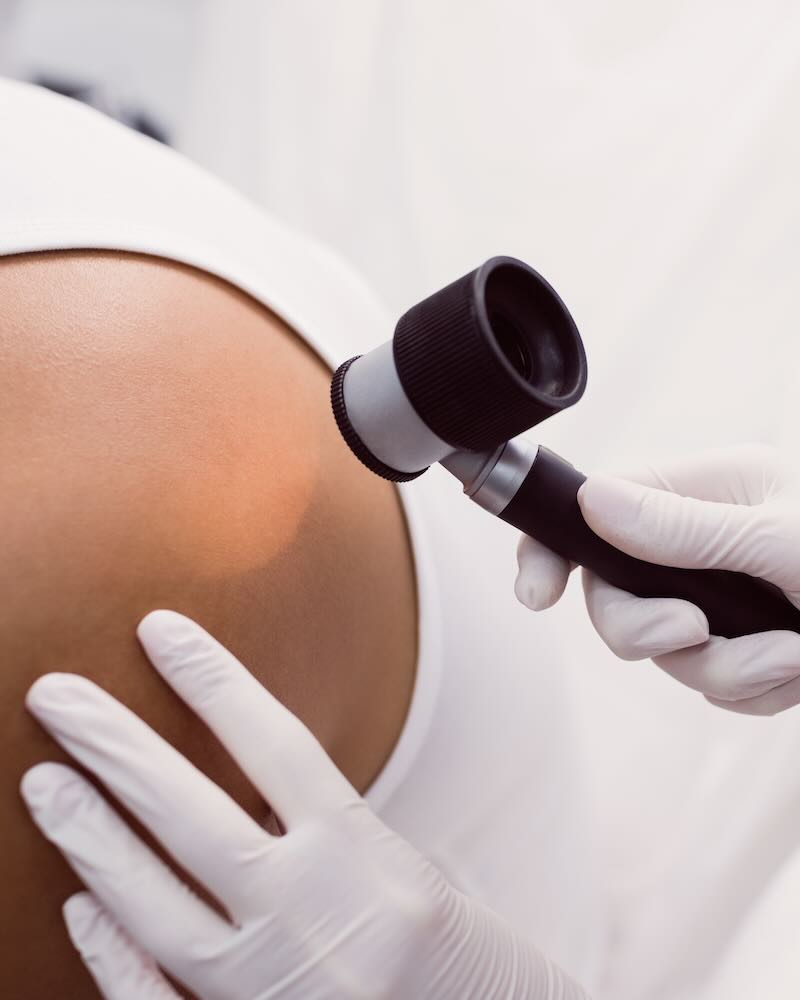 Doctor removing mole with laser treatment in clinic